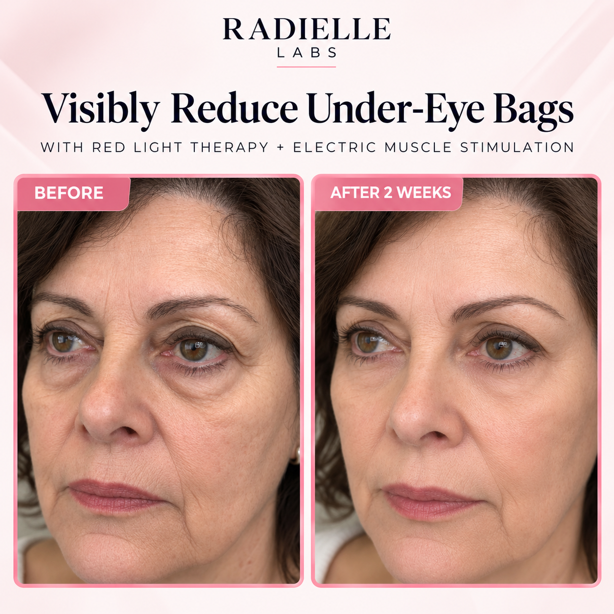 2-in-1 Red Light Therapy + EMS To Erase Eye Bags