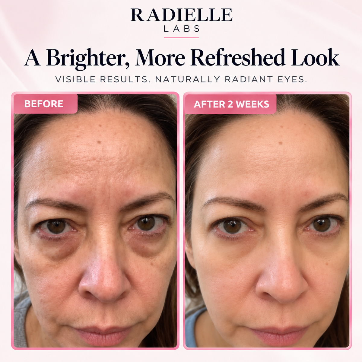 2-in-1 Red Light Therapy + EMS To Erase Eye Bags